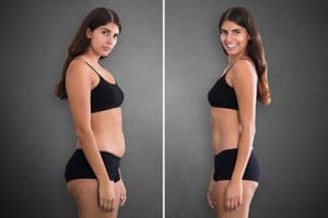Before and after photos of liposuction