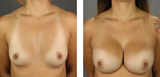 breast augmentation Temecula, CA