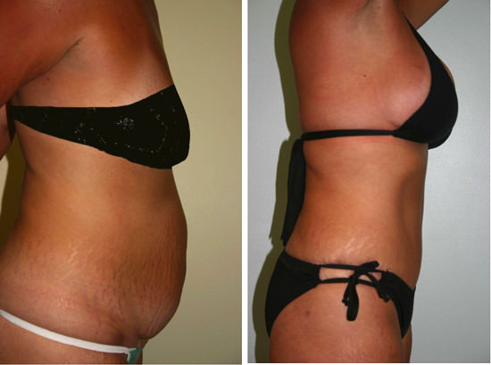 tummy tuck - abdominoplasty - tummy tuck before and after