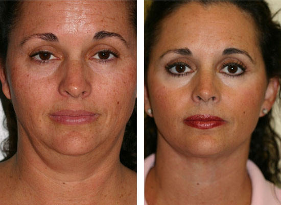 How Austin Facelift Surgery can Save You Time, Stress, and Money.