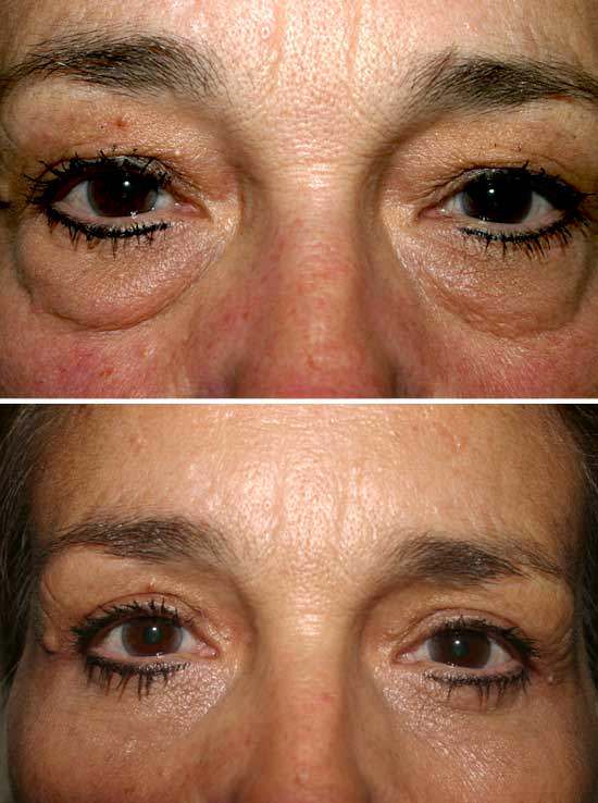 Eyelid Surgery Before and After