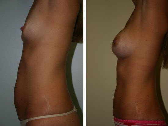 before and after abdominoplasty