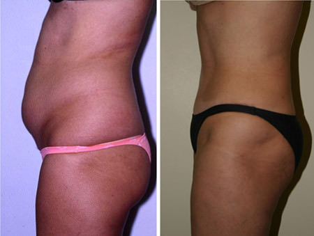 Abdominoplasty 10