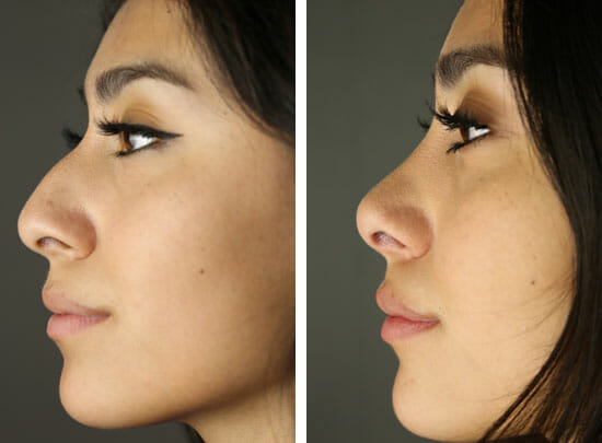 Before and after rhinoplasty surgery performed by Temecula plastic surgeon David Newman, MD