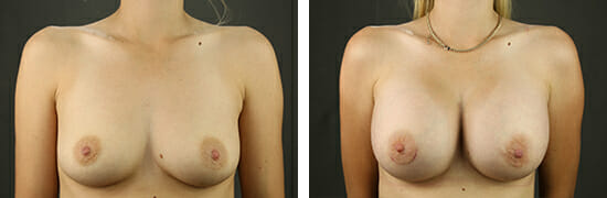 breast augmentation before and after photoes