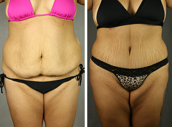 abdominoplasty before and after photos