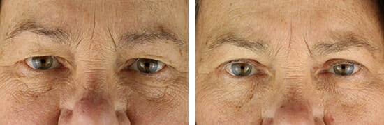 eyelid before and after photos