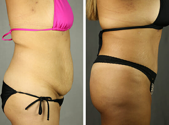 Tummy Tuck Before and Afer Photos