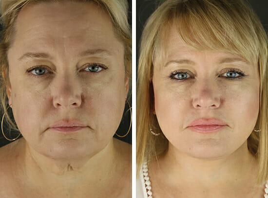 facelift surgery with before and after photos