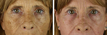 facial laser treatment
