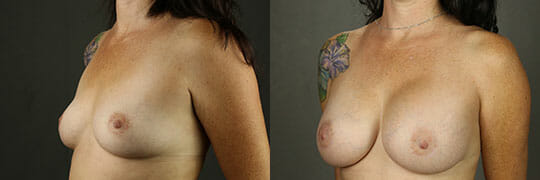 Breast Augmentation 54