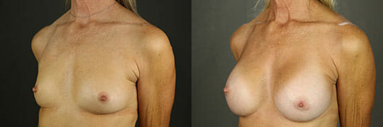 Breast Augmentation 54