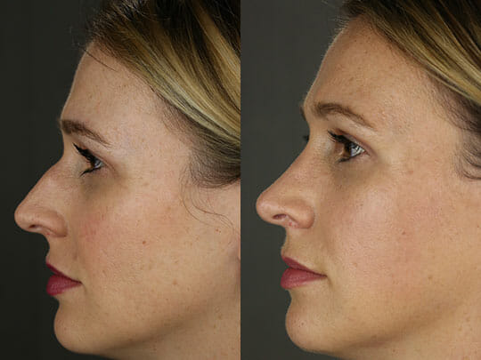 Before and after rhinoplasty surgery performed by Temecula plastic surgeon David Newman, MD