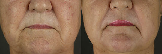 Laser skin resurfacing before and after photo