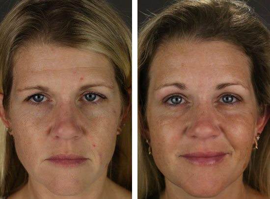 Photo of a patient of Dr. David Newman, Temecula Plastic Surgeon, before and after brow lift surgery.
