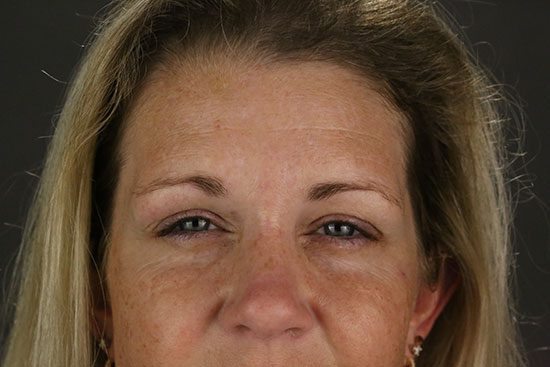 Photo of a patient of Dr. David Newman, Temecula Plastic Surgeon, after brow lift surgery.