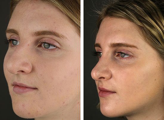 Photos of young woman with green eyes and blonde hair before and after rhinoplasty surgery performed by Temecula plastic surgeon David Newman, MD