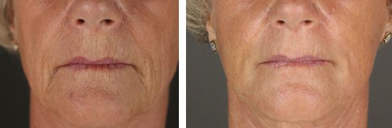 Laser Skin Resurfacing Before and After photo of the upper lip