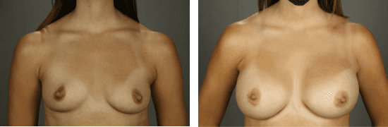 Breast Augmentation 56 Temecula, CA