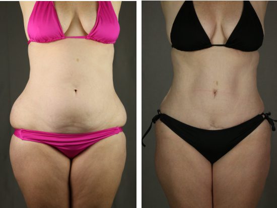 Liposculpture - Muffin Top Surgery Before and After Photos
