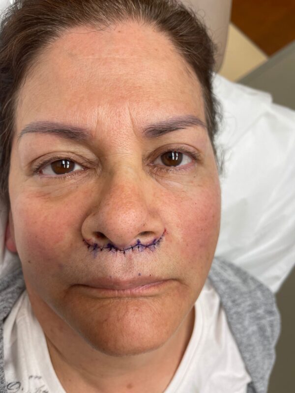 Lip Lift Post-Op