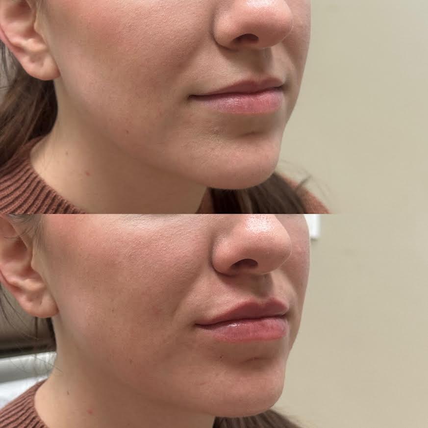 lip filler before and after photos in Murrieta