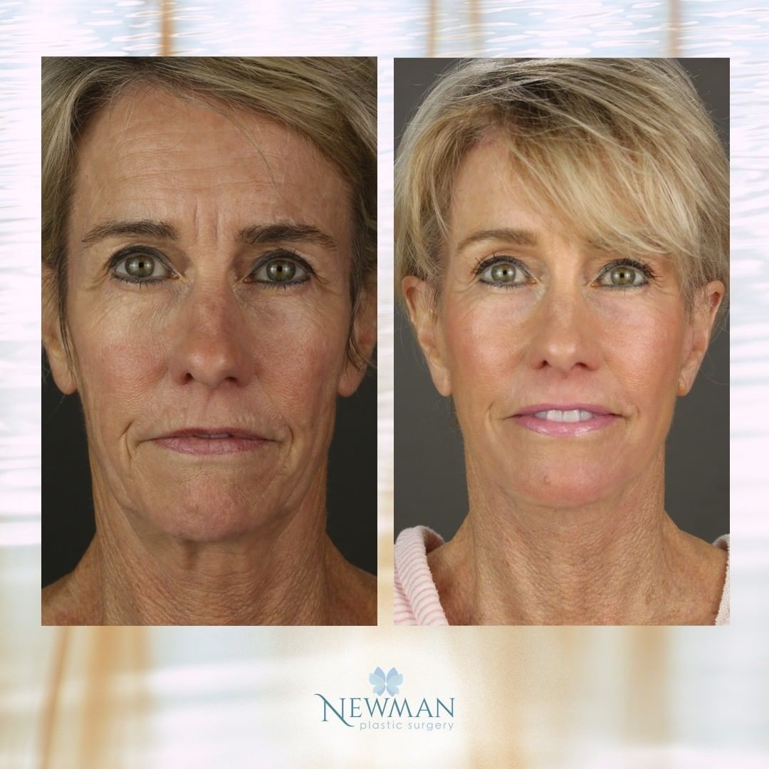 deep plane facelift before and after photo