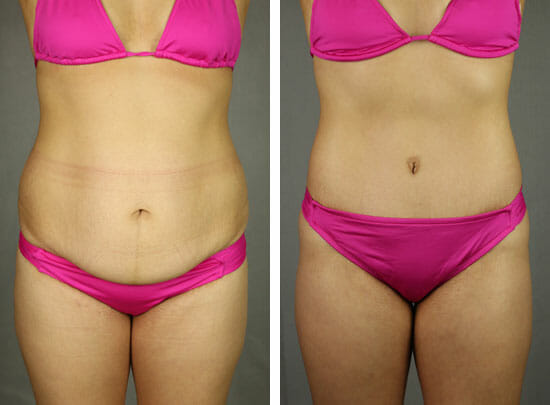 Woman in pink bikini before and after abdominoplasty, or muffin top surgery