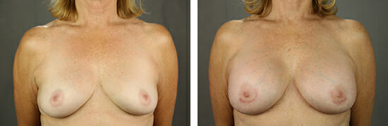 Breast Augmentation 51 Facing Center