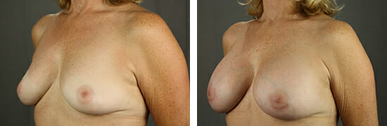 Breast Augmentation 51