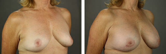 Breast Augmentation 51 Facing Right