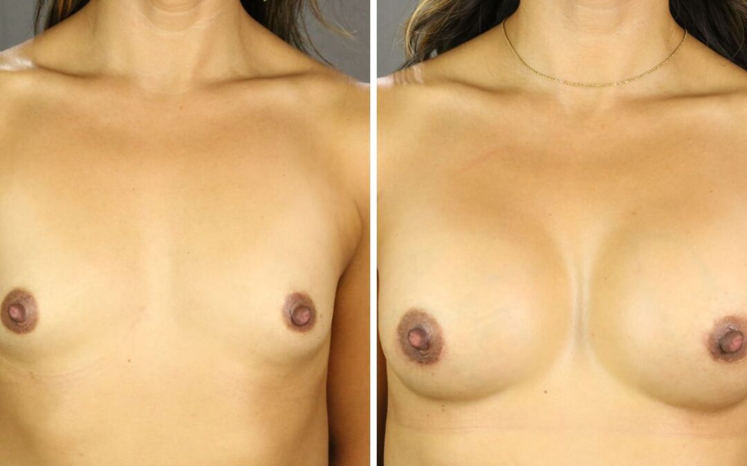 Breast Augmentation 59