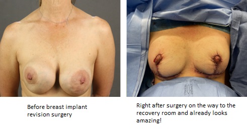 Breast Implant Revision 2