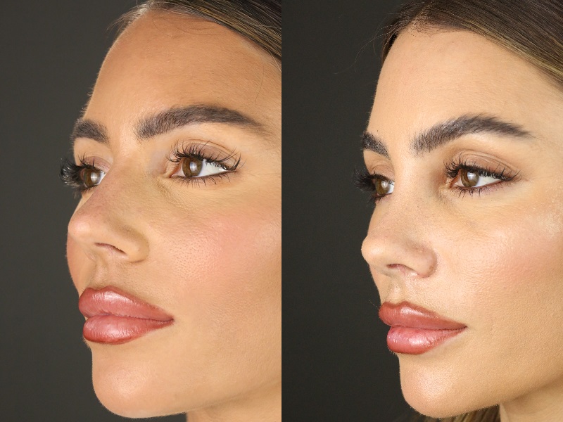 Before and After Rhinoplasty Facing Slightly Left