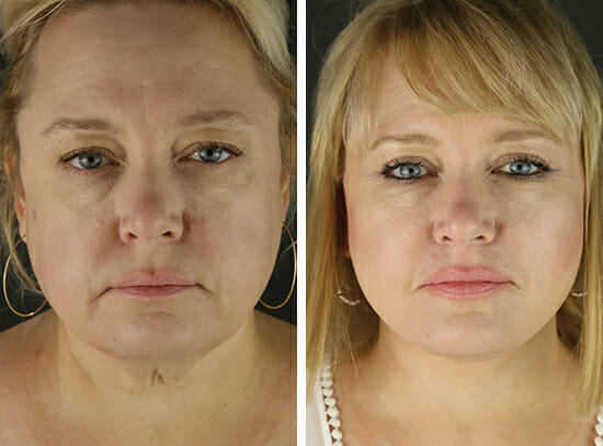 Before and After Rhinoplasty Facing Slightly Left