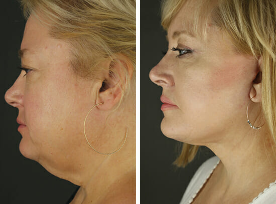 Before and After Rhinoplasty Facing Slightly Left