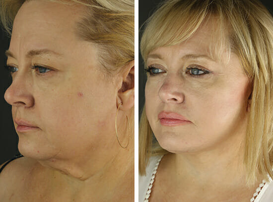 Before and After Rhinoplasty Facing Slightly Left