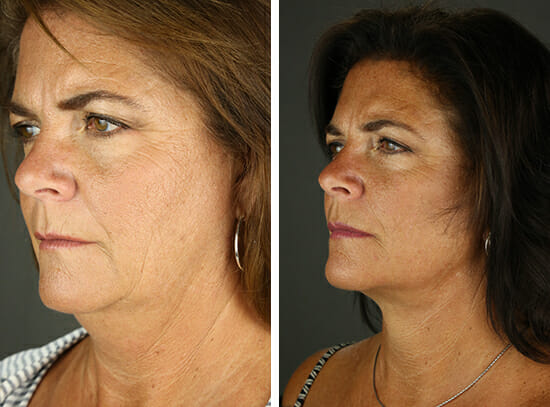 Before and After Rhinoplasty Facing Slightly Left