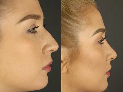 Rhinoplasty Patient Facing Right