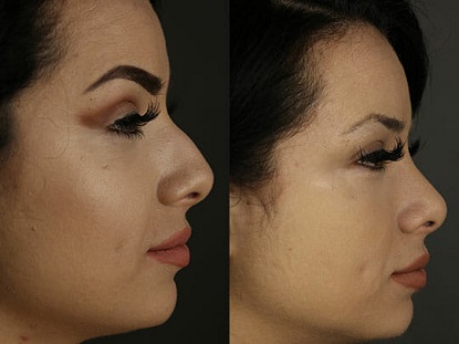 Rhinoplasty Patient Facing Right