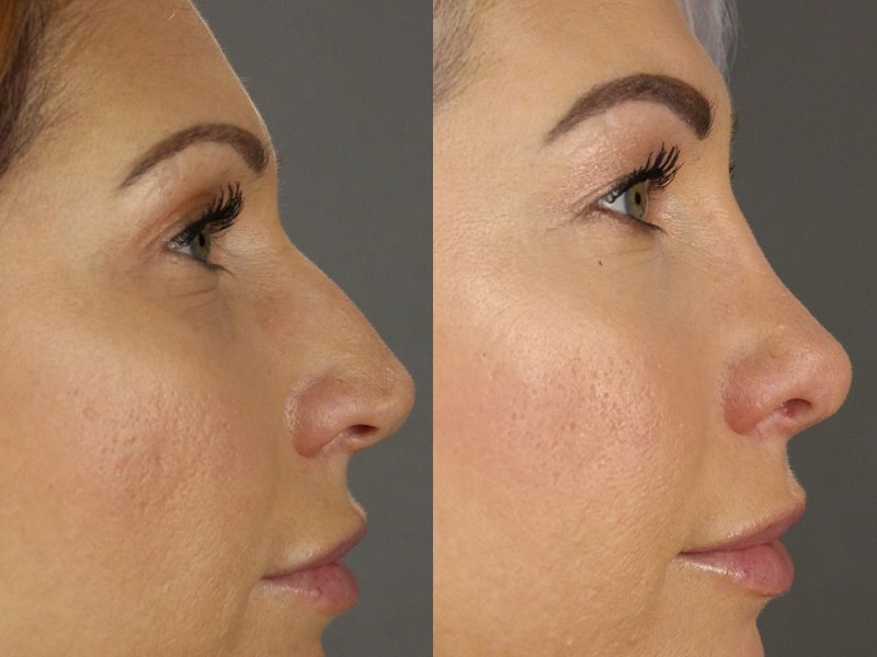 Rhinoplasty patient before and after facing right