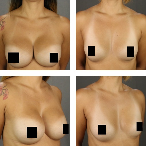 Breast Augmentation Before and After Photos 1