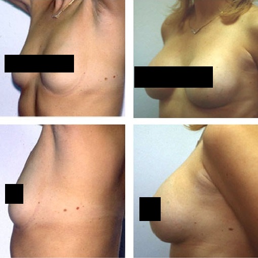 Breast Augmentation Before and After Photos 2