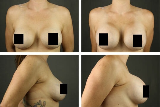 Breast Implant Revision Before and After Images