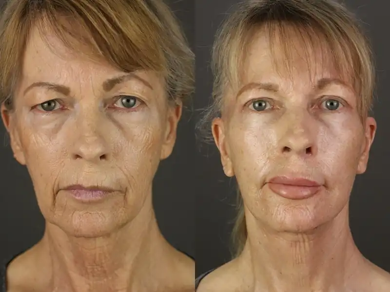 Facelift patient