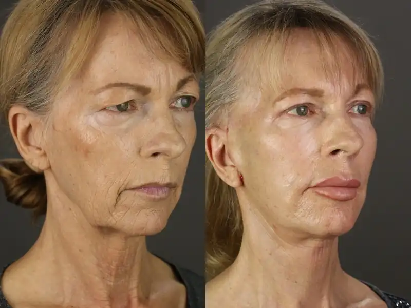 Facelift patient